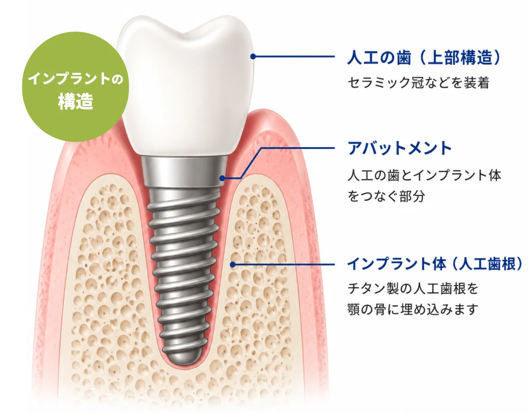 インプラントの構造：人工の歯（上部構造）、アバットメント、インプラント体（人工歯根）